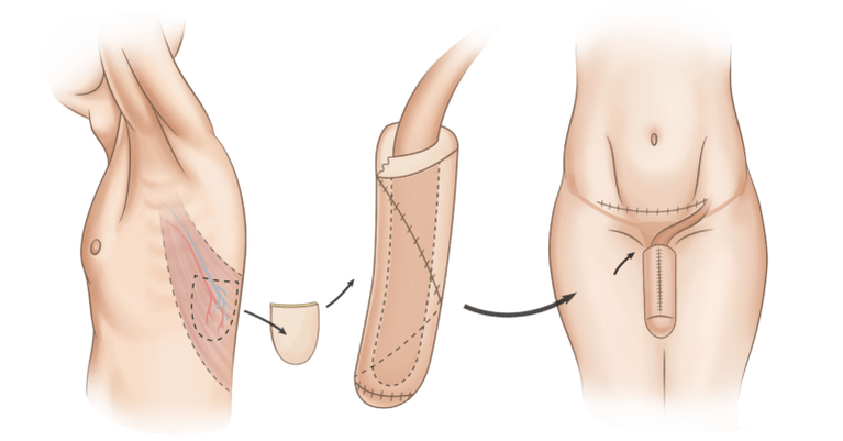 phalloplasty for penis enlargement